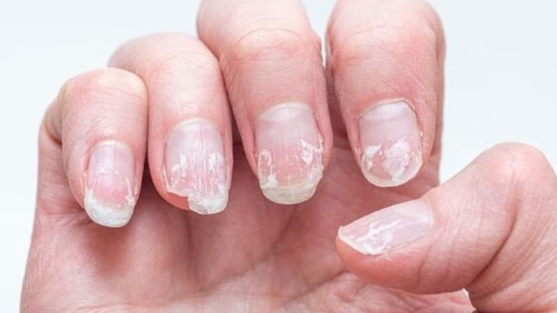 Góc nhìn văn hóa và tâm linh về gãy móng tay