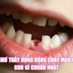 Nằm Mơ Thấy Rụng Răng Chảy Máu Đánh Con Gì Chuẩn Nhất