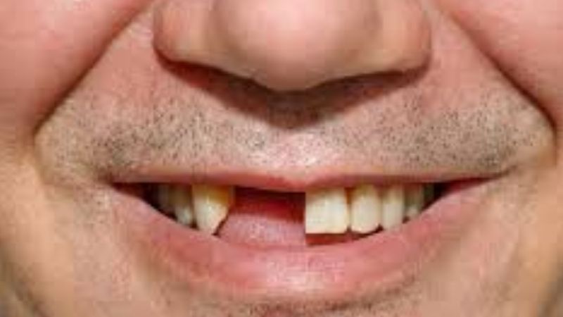 Ý Nghĩa Tổng Quan Khi Mơ Thấy Rụng Răng Chảy Máu