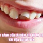 Bị Gãy Răng Cửa Là Điềm Gì? Hé Lộ Sự Thật Khi Vận Rủi Ập Đến