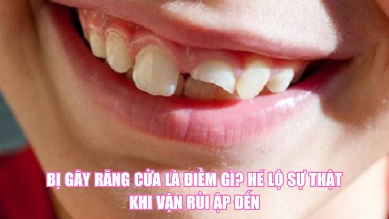 Bị Gãy Răng Cửa Là Điềm Gì? Hé Lộ Sự Thật Khi Vận Rủi Ập Đến