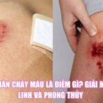 Đứt Chân Chảy Máu Là Điềm Gì? Giải Mã Tâm Linh Và Phong Thủy