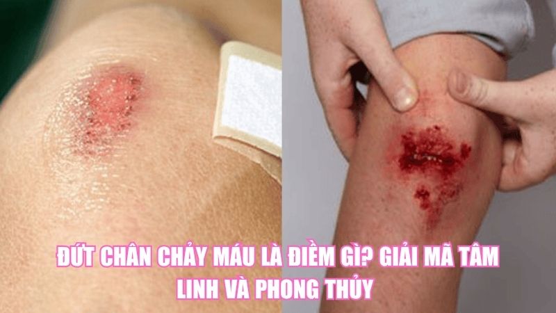 Đứt Chân Chảy Máu Là Điềm Gì? Giải Mã Tâm Linh Và Phong Thủy