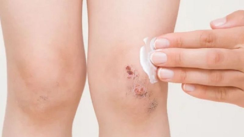 Giải mã đứt chân chảy máu là điềm gì theo dân gian?