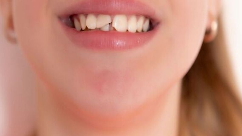 Góc nhìn khoa học: Khi nào mẻ răng là tín hiệu y học cần chú ý?