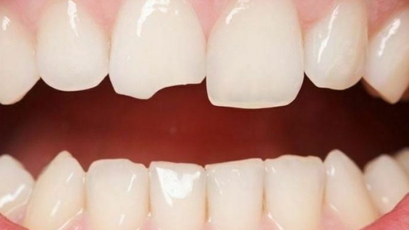 Mẻ răng là gì? Nguyên nhân thường gặp bạn nên biết