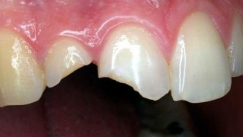 Quan niệm dân gian về gãy răng cửa