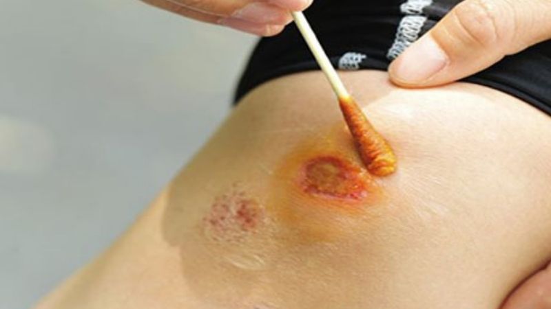 Ý nghĩa chung của việc đứt chân chảy máu