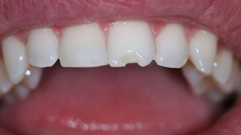 Ý nghĩa trong giấc mơ: Mơ thấy gãy răng cửa là điềm gì?